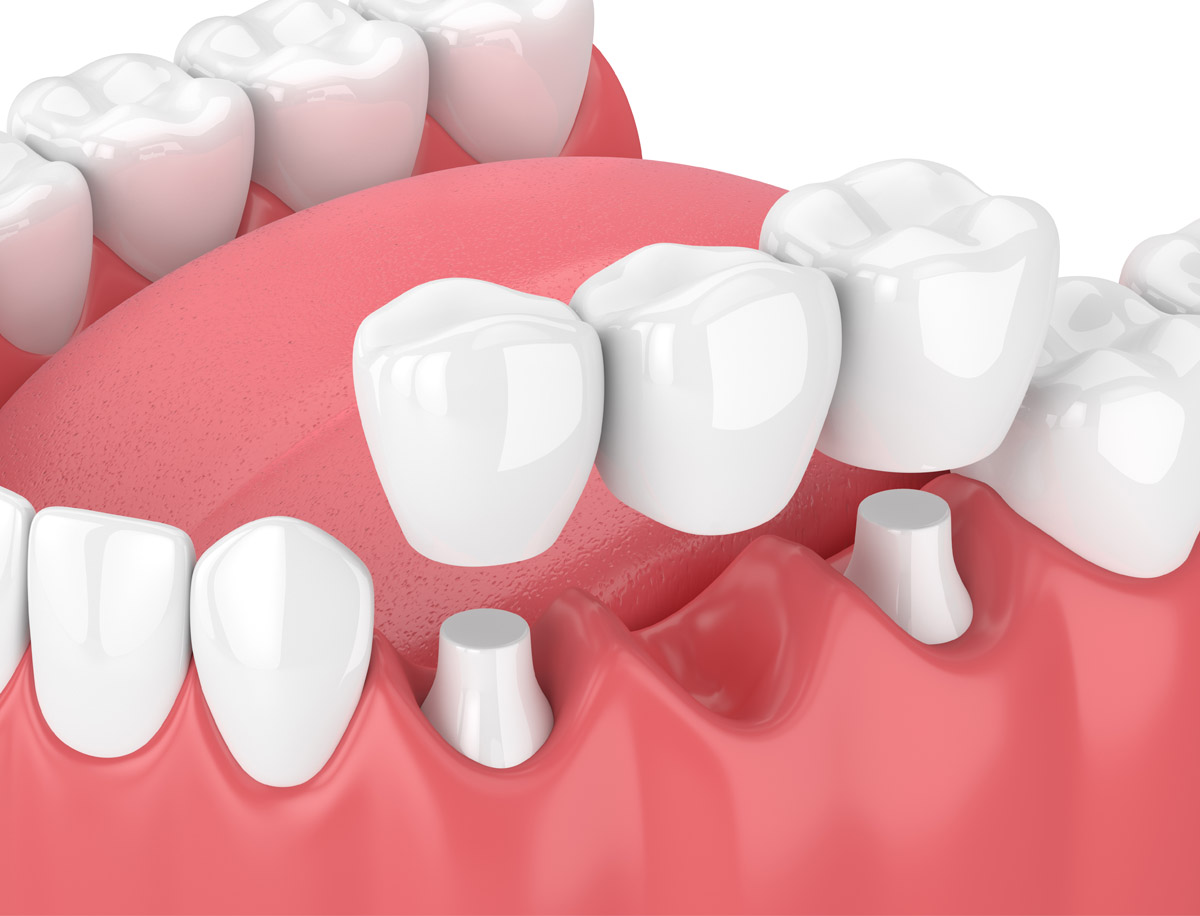 Dental Implants: What to Expect During the Healing Process
