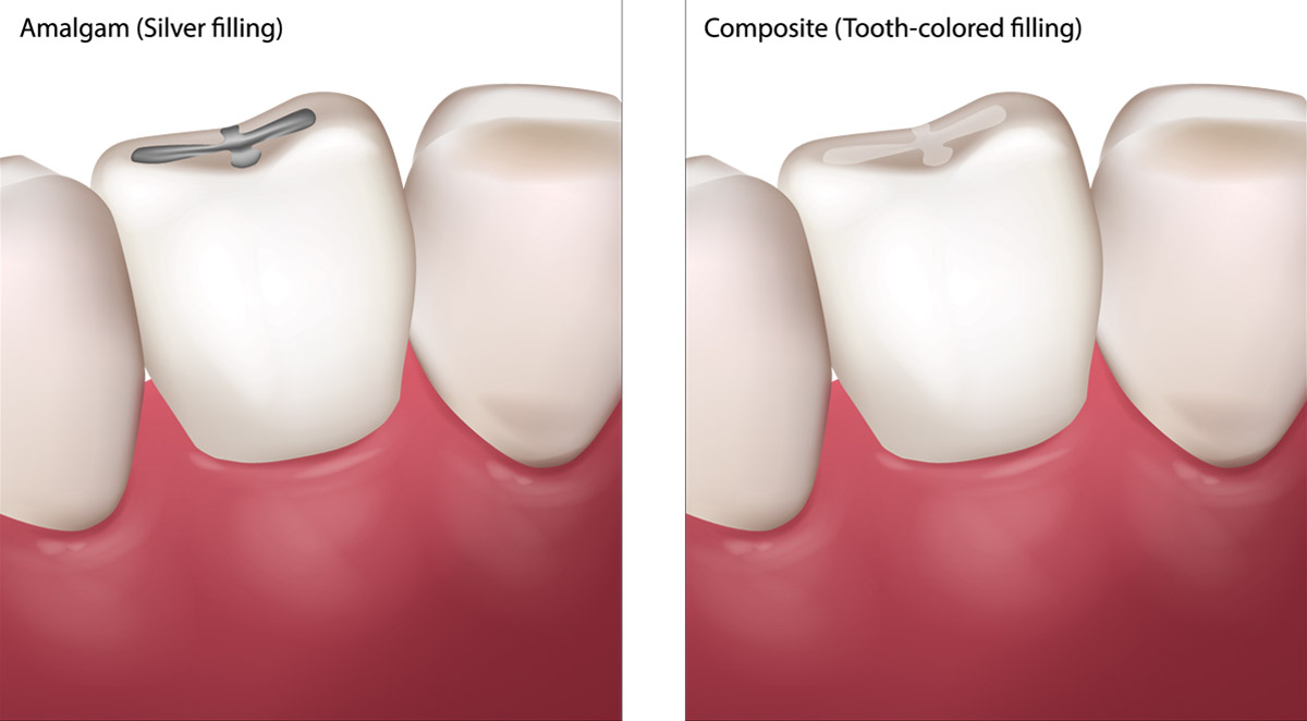 Dental Fillings & Restorations