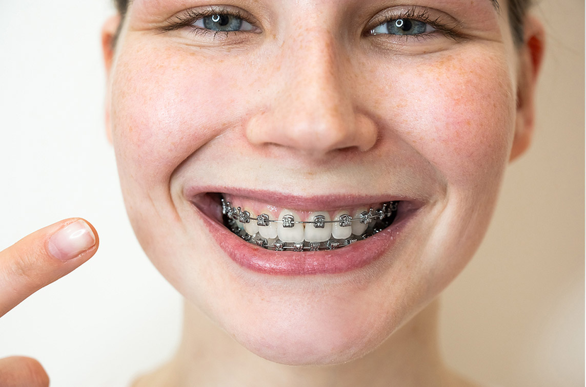 When Should You Consider Braces or Clear Aligners?