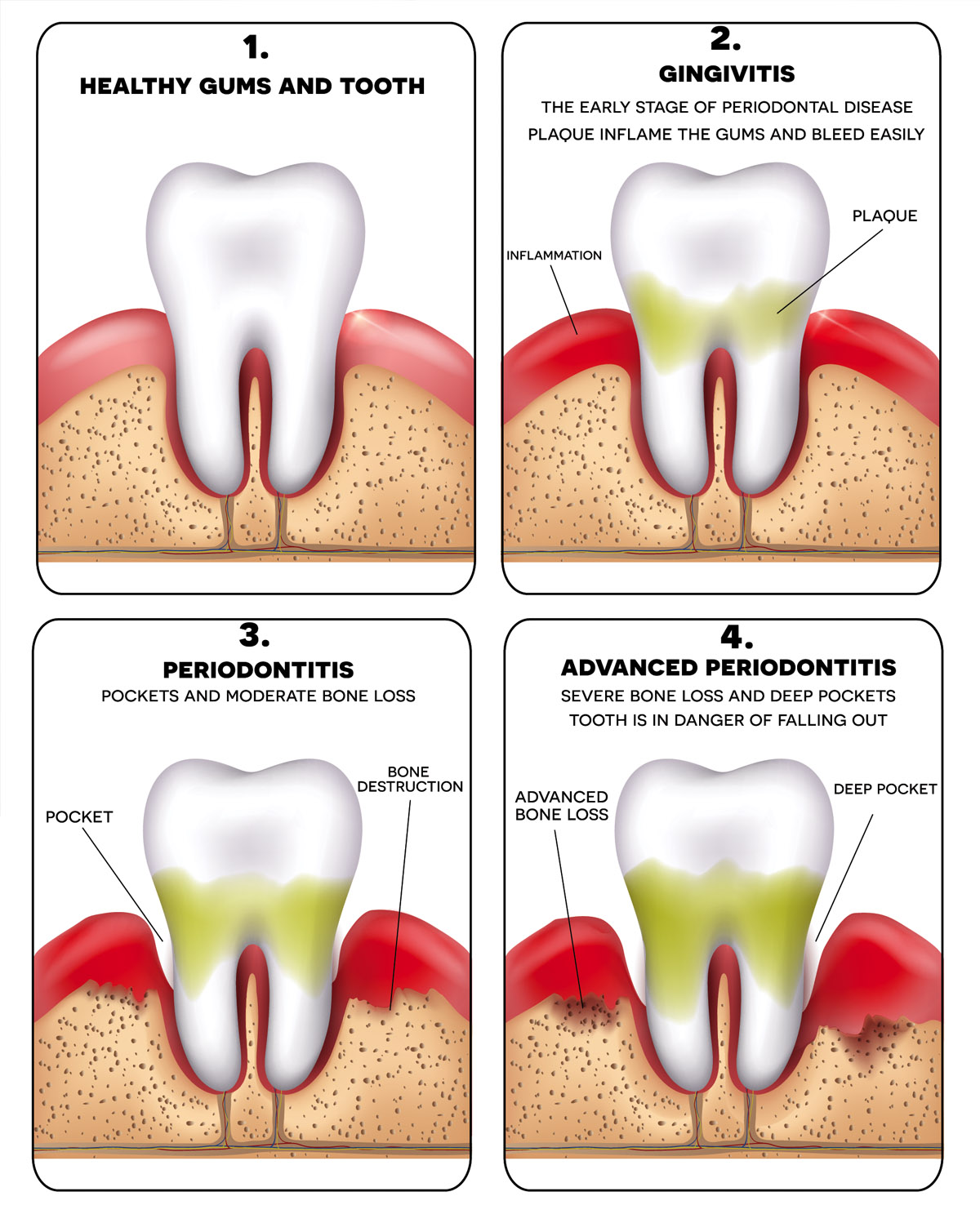 Gum Disease Treatment (Periodontics)