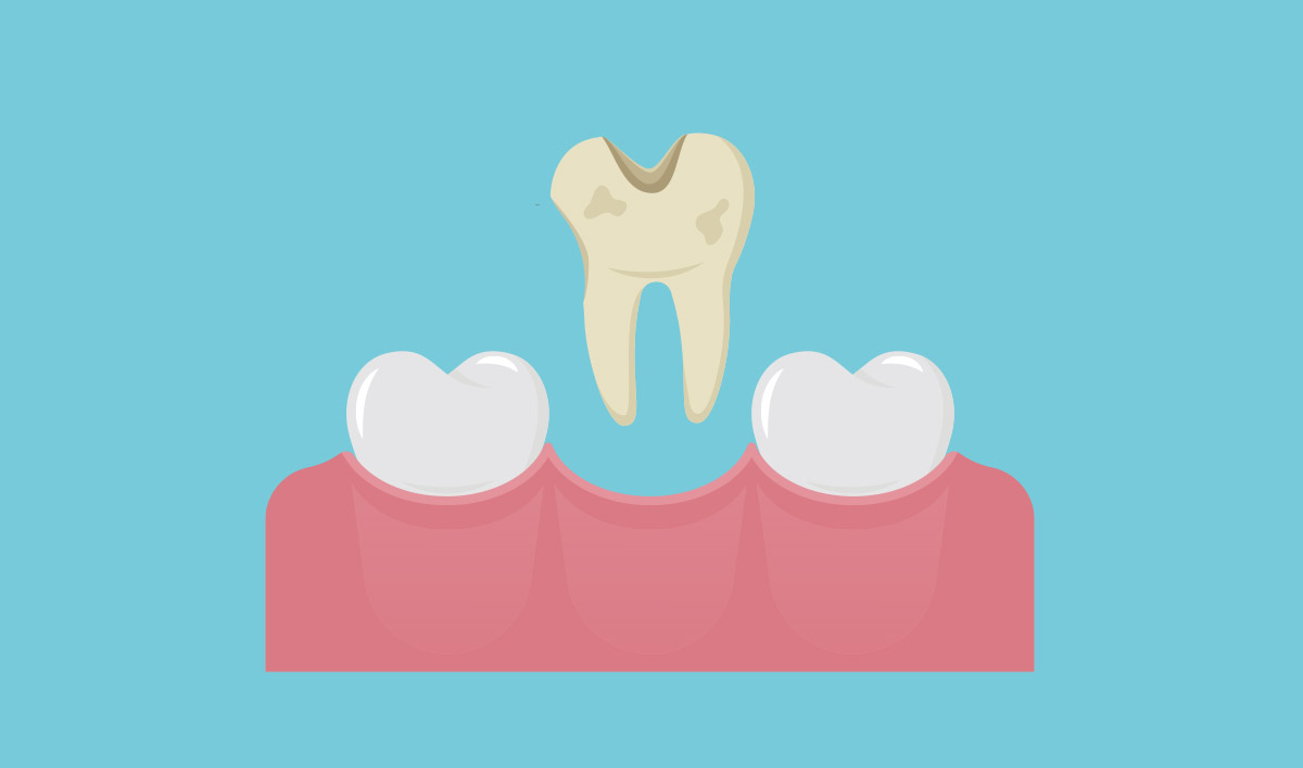 Tooth Extractions & Wisdom Teeth
