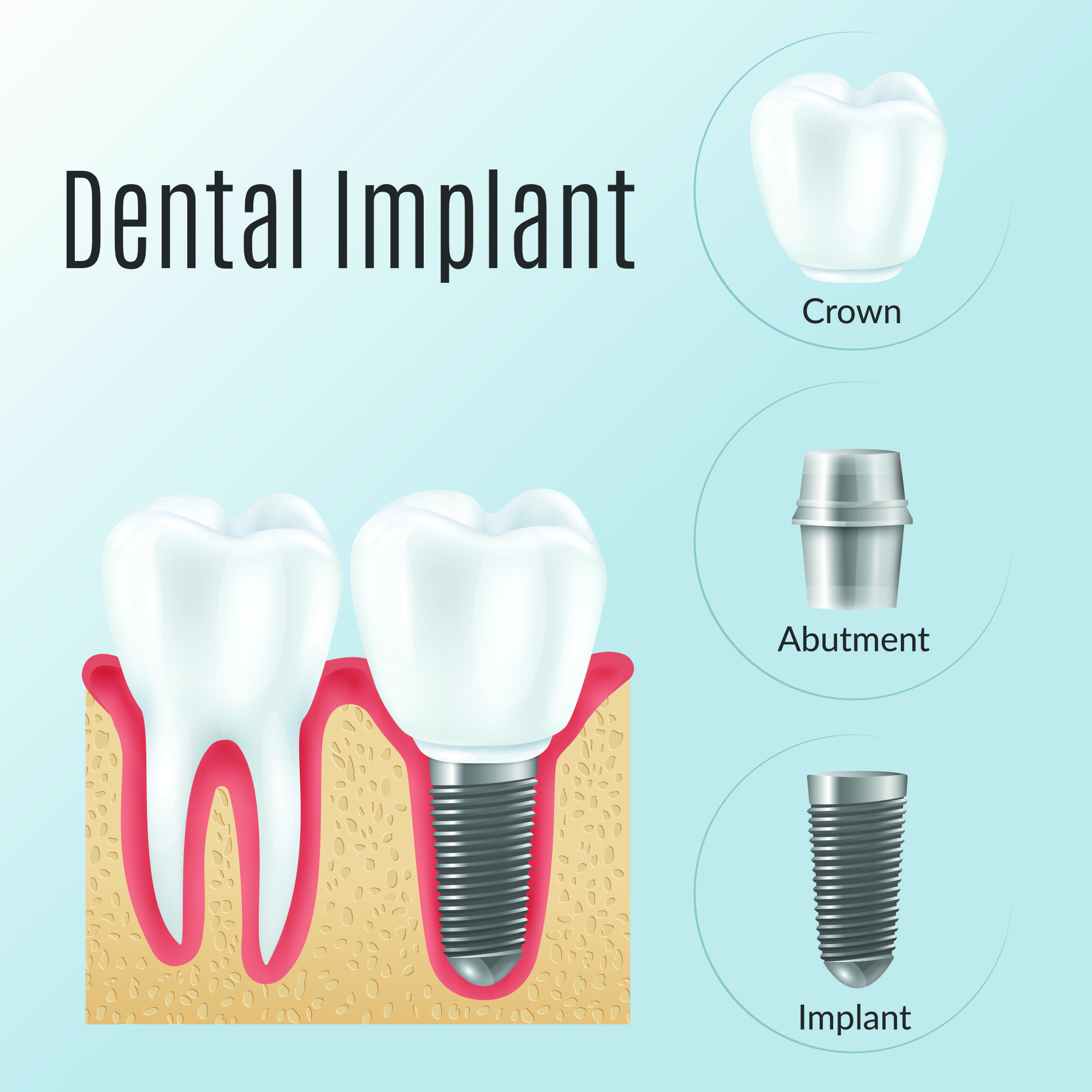 Dental Implants