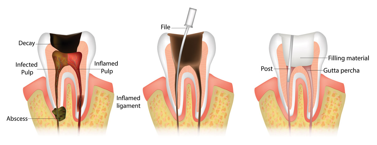 Root Canal Treatment (Endodontics)